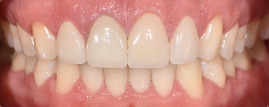 Smile Gallery - After