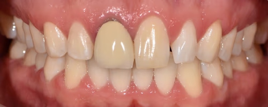 Smile Gallery - Before