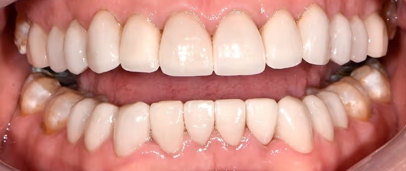 Smile Gallery - After
