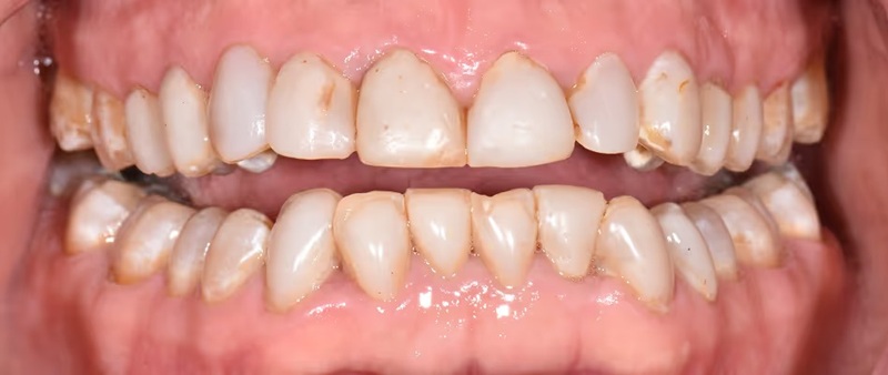 Smile Gallery - Before