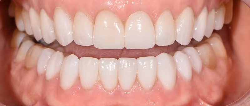 Smile Gallery - After