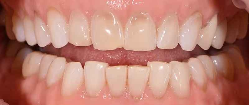 Smile Gallery - Before