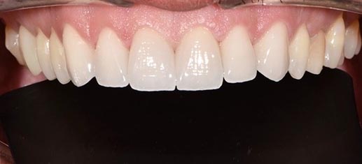 Smile Gallery - After