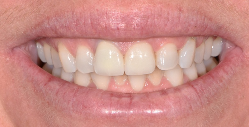 Smile Gallery - After
