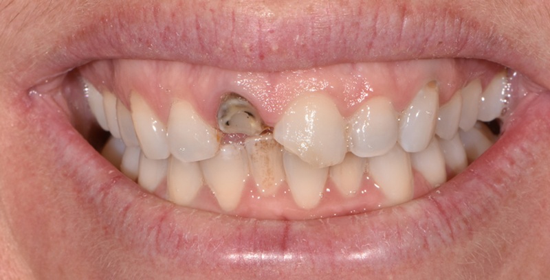 Smile Gallery - Before